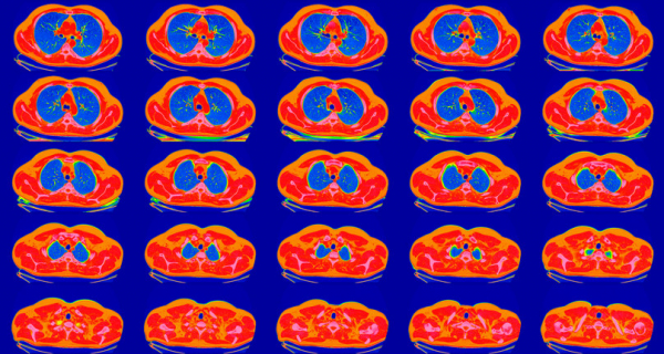 CT scan showing multiple crosss-sections of a lung in shades of red, blue, and yellow on a purple background 